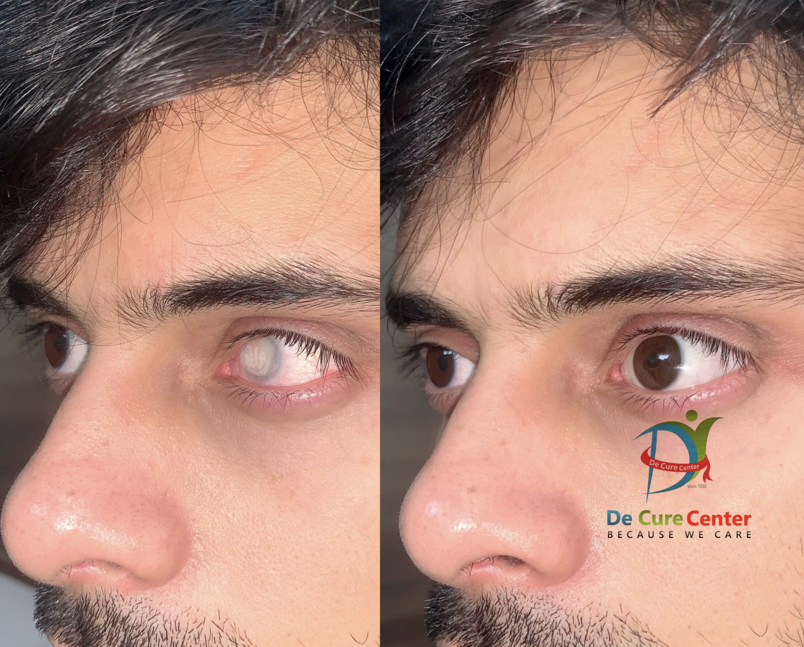 Custom-Made Prosthetic Eyes  Integrated Ocular Prosthetics