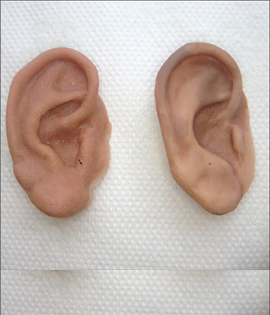 Ear Prosthesis