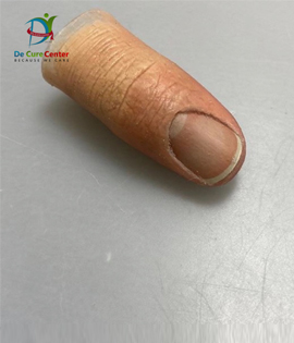 Finger Prosthesis