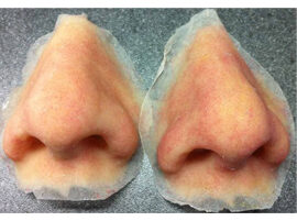 Nose Prosthesis